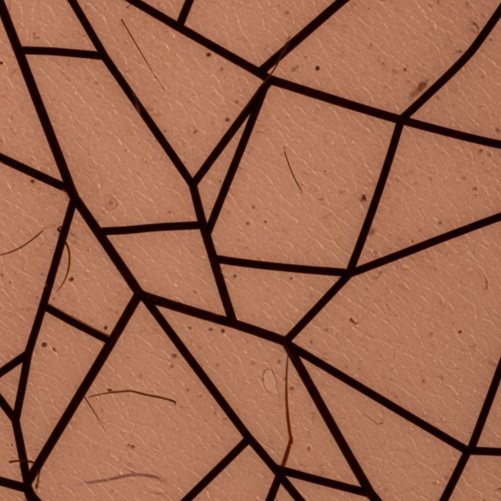 Understanding angulated lines: Key dermoscopic feature in lentigo maligna and sun-damaged skin melanomas.
