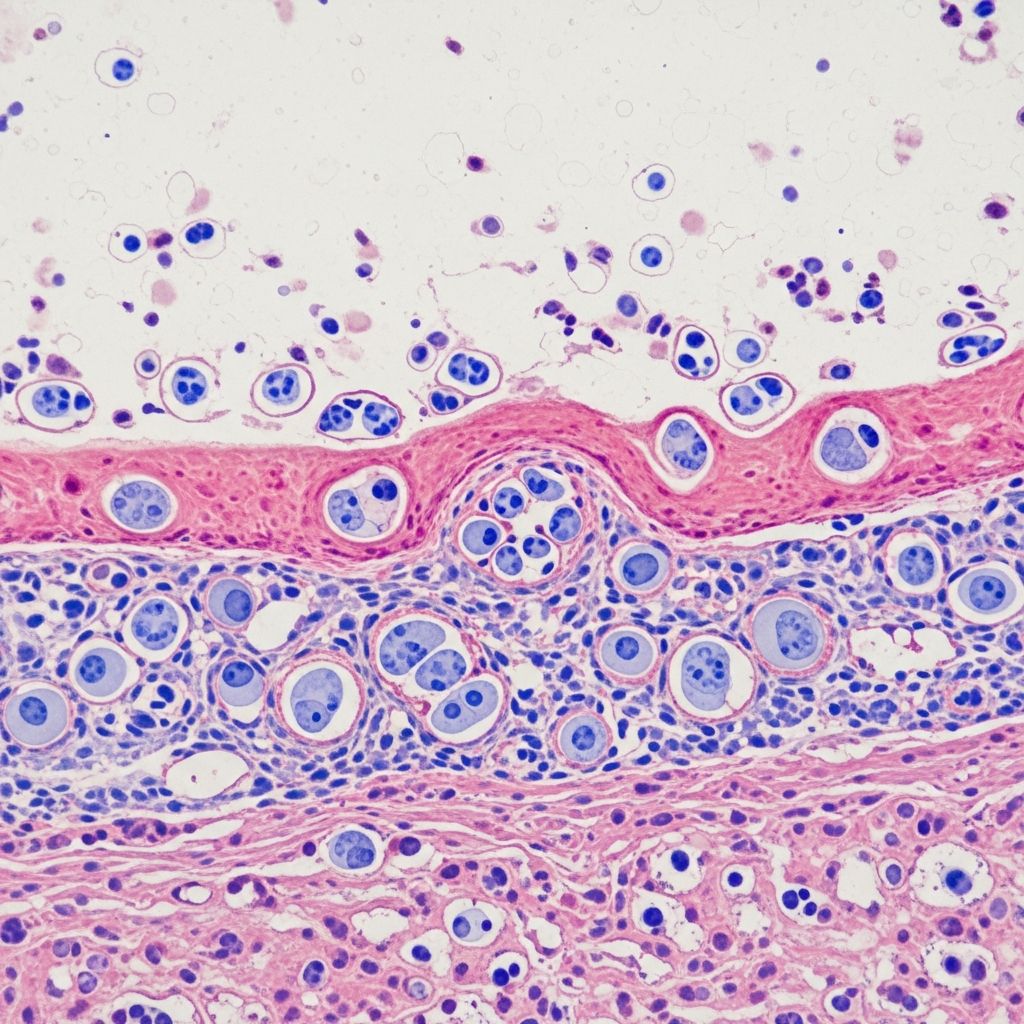Detailed histopathological examination and diagnostic features of mycosis fungoides, the most common cutaneous T-cell lymphoma.