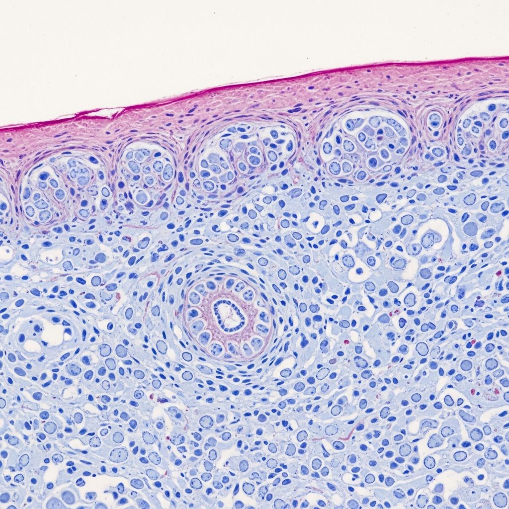 Detailed pathology of reticular erythematous mucinosis, a rare cutaneous mucinosis with distinctive histological features.