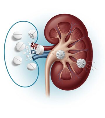 Explore the vital role, risks, and guidelines for using calcium supplements in managing chronic kidney disease effectively.